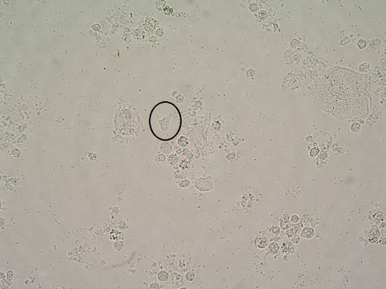 Trichomoniáza