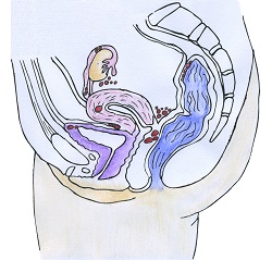 Endometrióza