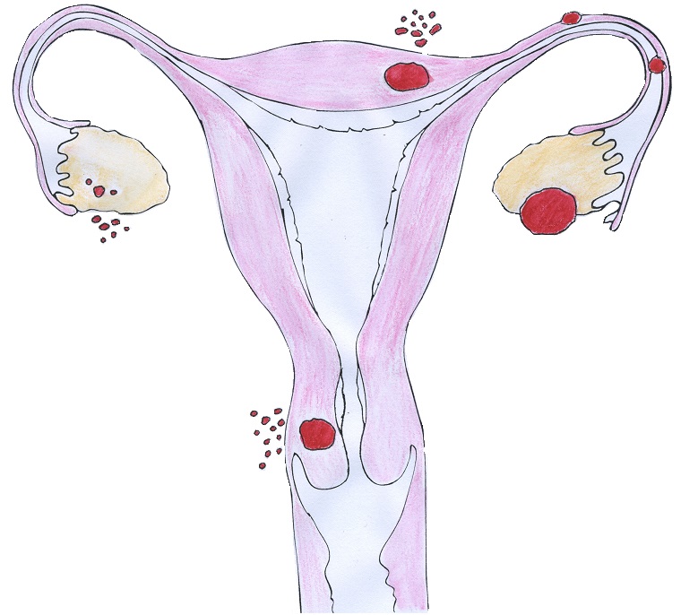 Endometrióza
