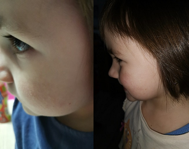 Lenka (1. část): Viditelné změny zatím nepozoruji, účinky Bactodermalu mohla zpomalit nemoc