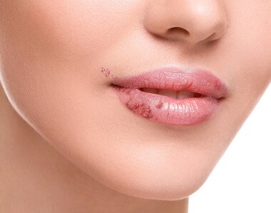 Herpetická stomatitida a opar na rtech