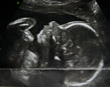 Rodíme ONLINE: miminko se otočilo