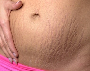 Strie v těhotenství