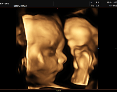 Petra si ve 26. TT ze 4D ultrazvuku přivezla krásné fotky i video