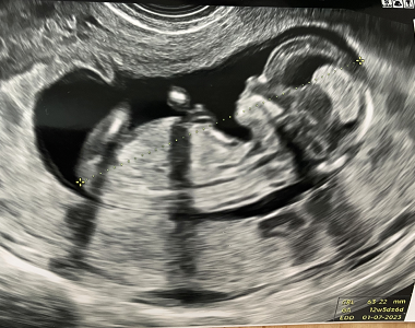 Kamila ve 14. TT absolvovala prvotrimestrální screening. Jak dopadl?