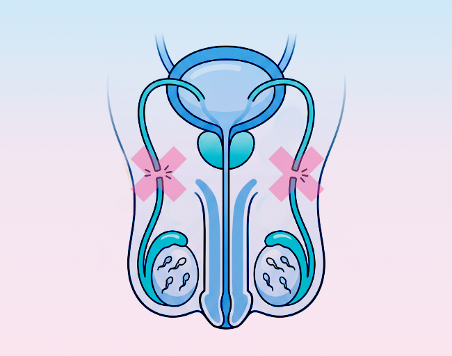 Vazektomie: mužská antikoncepční metoda