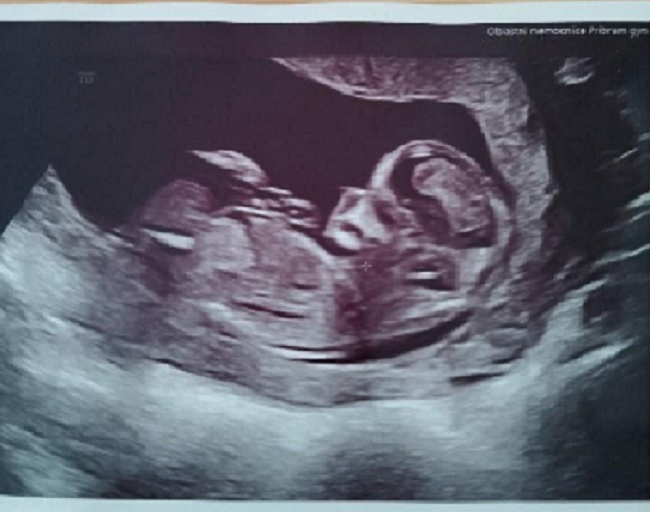 Míša: Průběh IVF po neúspěšné inseminaci