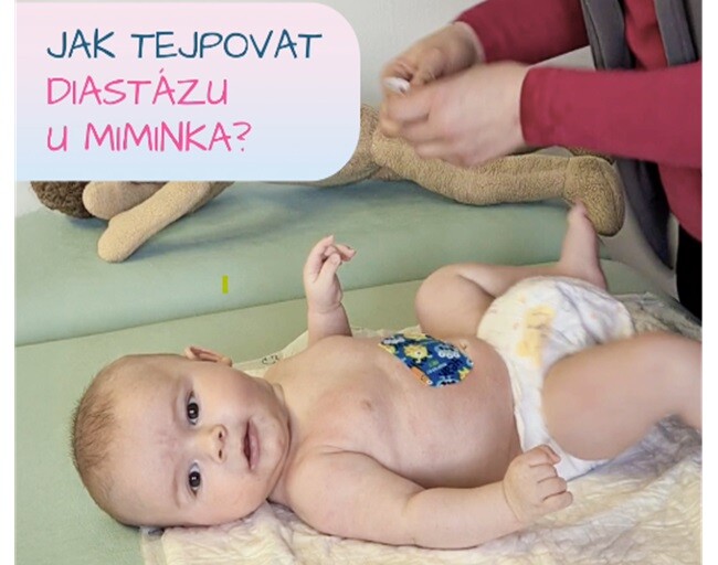 Jak tejpovat diastázu u miminka?