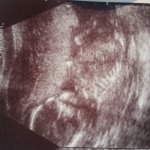Foto z ultrazvuku