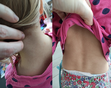 Kateřina (1. část): Po měsíci užívání probiotik Bactodermal baby ekzém ustupuje