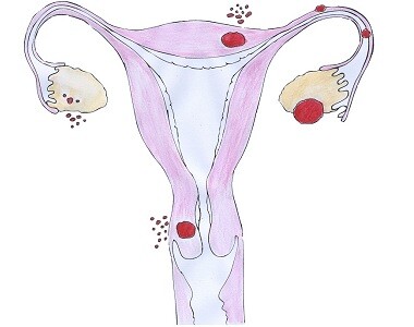 Endometrióza
