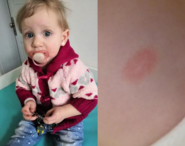 Helena (1. část): Červené fleky zmizely, po ekzému zůstávají jen sušší místa