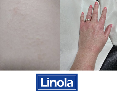 Náhledový obrázek pro článek Jarmila testuje tělové mléko Linola Lotion